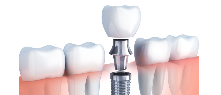 Dental Implants